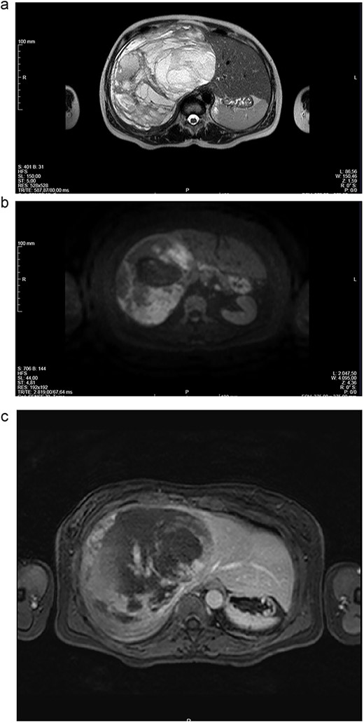 (a-c) Magnetic resonance imaging (MRI) scans of a woman aged 49 years with undifferentiated embryonal sarcoma of the liver. Liver of increased dimensions, due to the presence of a voluminous oval mass and well-defined limits occupying the entire right lobe. Heterogeneous mass with enhanced thin septa in the right lobe of the liver with fluid levels suggestive of atypical hemangioma. The right hepatic vein not dissociable to the tumor.