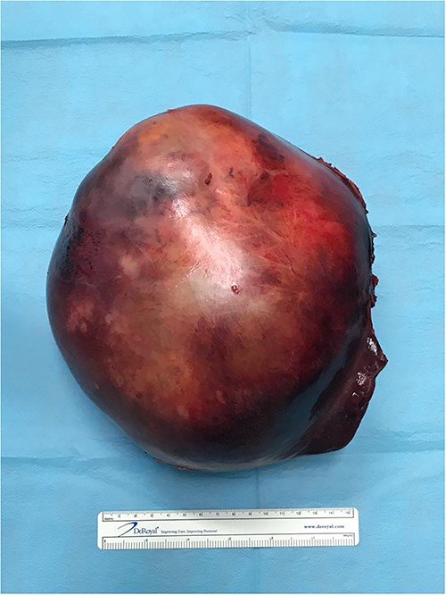Sarcoma with a maximum diameter of a 20 cm.