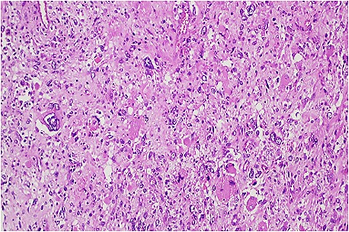 Hypercellular tumor showing severely pleomorphic neoplastic cells with occasional multinucleation.