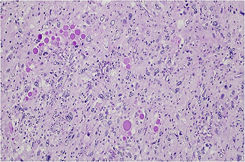 PAS-diastase positive hyaline globules are a main feature of embryonal sarcoma of the liver.