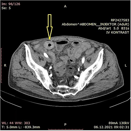 Abdominal CT scan showing small bowel wall thickening described as chronic small bowel obstruction (arrow).