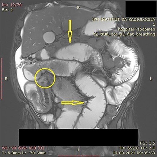 MR enterography with dilated small bowel loops (arrows) and visible zone of transition with visual tumor in the ileum (encircled).