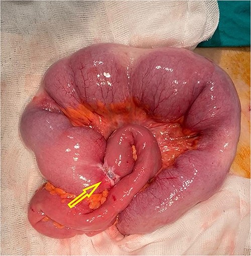 Intraoperative finding with visual obstructive small bowel tumor (arrow).