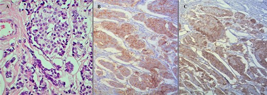 (A) Hematoxylin and eosin stain of the tumor. (B) Synaptophysin stain positivity. (C) Chromogranin stain positivity.