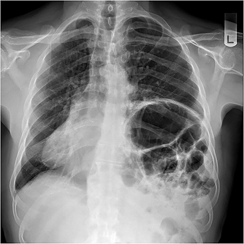 Chest X-ray performed preoperatively.