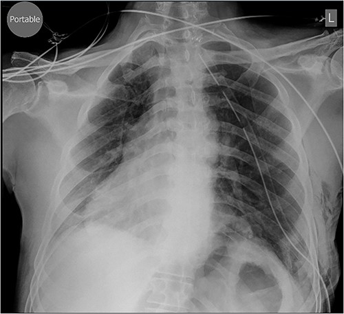 Chest X-ray performed Day 1 postoperatively.