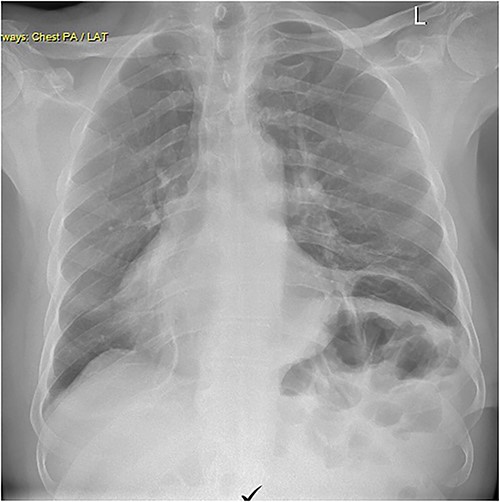 Chest X-ray performed 2 years post-procedure.