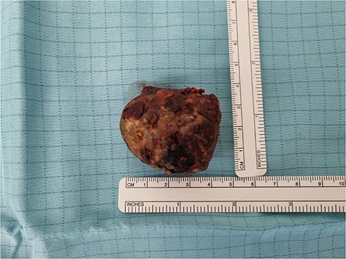 Picture of the gallstone.