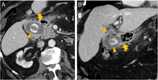 Abdominal CT in axial (A) and oblique paracoronal reconstruction (B); gallstone in the duodenal bulb (arrowhead ), pylorus (thick arrow ), chronically inflamed, and collapsed gall bladder with fistula to the duodenum (thin arrow ); image courtesy of Gerald Wolf, State Hospital Western Styria, Austria.
