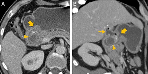 Abdominal CT in axial (A) and oblique parasagittal reconstruction (B); gallstone in the duodenal bulb (arrowhead ), pylorus (thick arrow ), chronically inflamed, and collapsed gall bladder with fistula to the duodenum (thin arrow ); image courtesy of Helmut Schöllnast, State Hospital Graz II, Austria.