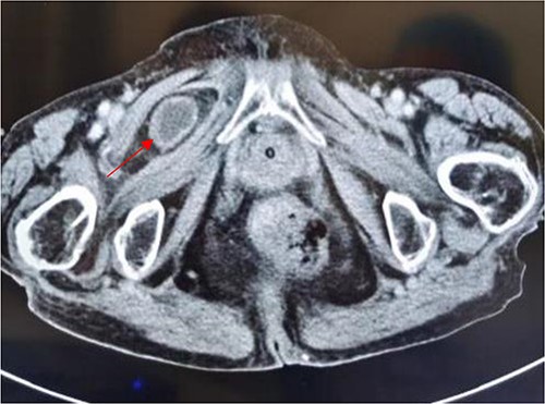 Computed tomography axis map showing the small intestine entering the femoral triangle (red arrow).