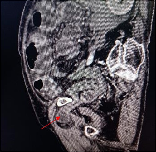 Sagittal view shows a right obturator hernia (indicated by red arrow).