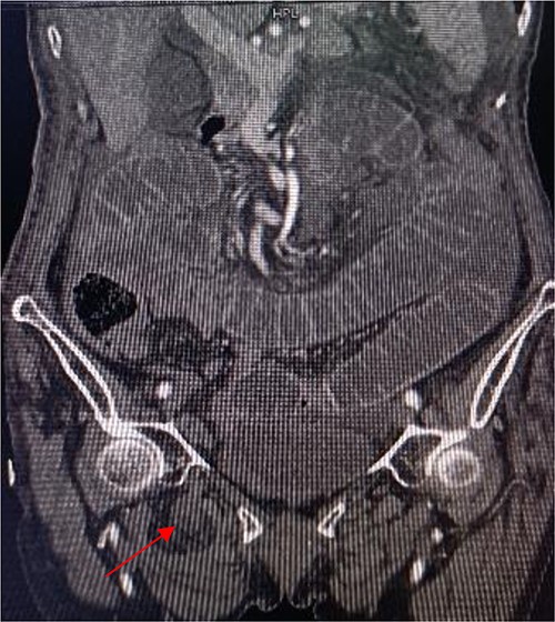 Coronal view shows right obturator hernia entering the intestinal canal (indicated by red arrow).