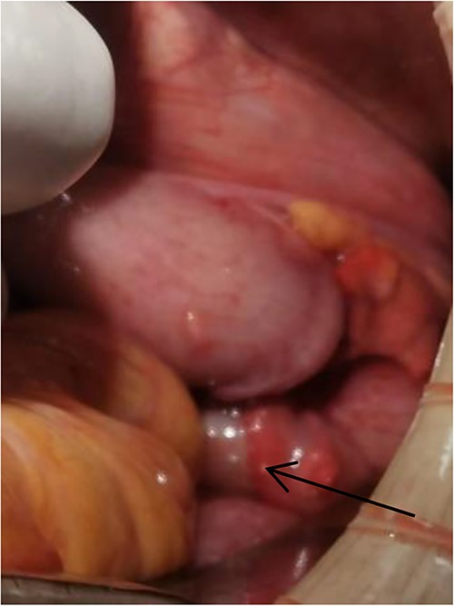Tumor (indicated by black arrow) on the ascending colon observed during operation.