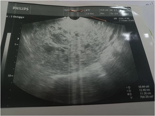 Several cystic vesicles on the right side of the uterus.