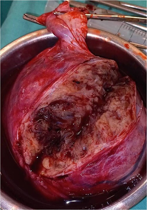The mass after resection measured (10 × 14) cm.
