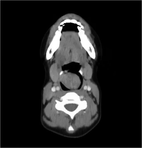 CT of the neck with axial cut showing the schwannoma occupying the larynx.