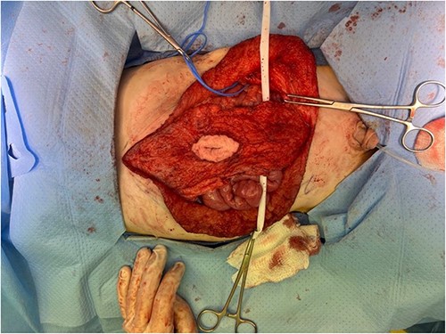 Surgical dissection of rectus muscles. A blue vessel loop encircles the right spermatic vessels.