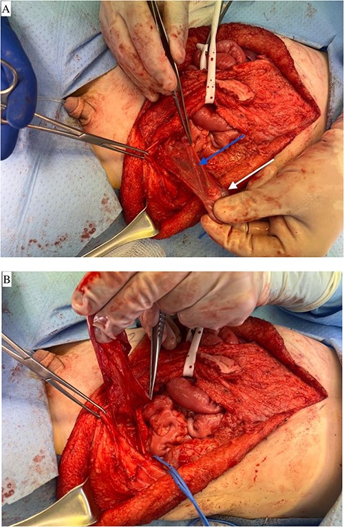 (A) Left testicle mobilized on the collateral vessels adjacent to the vas deferens. Blue arrow notes vas deferens and white arrow notes left testicle. (B) Left testicle mobilized on the collateral vessels adjacent to the vas deferens. Demonstrates a medial reflection of the mobilization depicted in A.