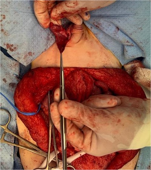 The left testicle was carefully brought down into the subdartos pouch and secured in place in the left hemiscrotum.