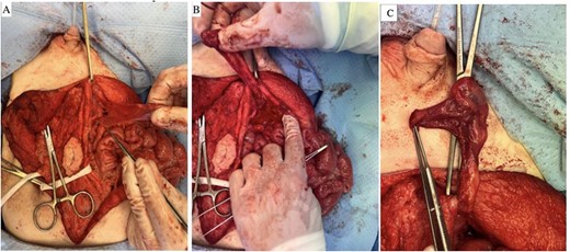 (A–C) Myofascial flap raised along the deep inferior epigastric vessels down to the level of the external iliac artery.