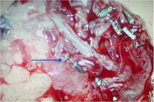 Completed microvascular anastomosis of deep inferior epigastric and testicular arteries using 10-0 interrupted nylon sutures (red arrow). Adjacent (blue arrow) is the completed anastomosis of the deep inferior epigastric vena comitans and testicular vein.