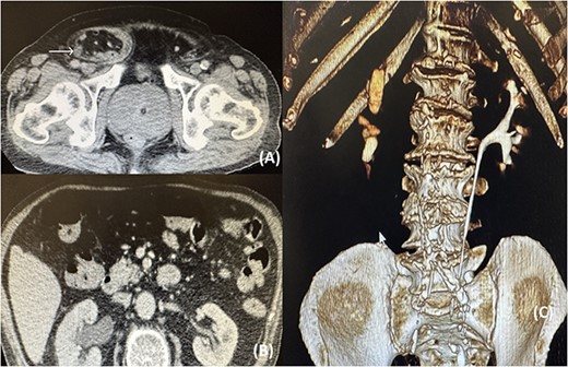 (A) CT image showing the right ureter (arrow) entrapped within the hernia; (B) CT image showing the pelvicalyceal dilatation of the right kidney because of the distal ureteral entrapment; (C) CT reconstruction showing no illustration of the right ureteral system.