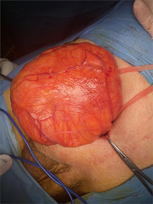Intraoperative image showing the large hernia containing a large amount of retroperitoneal fat.