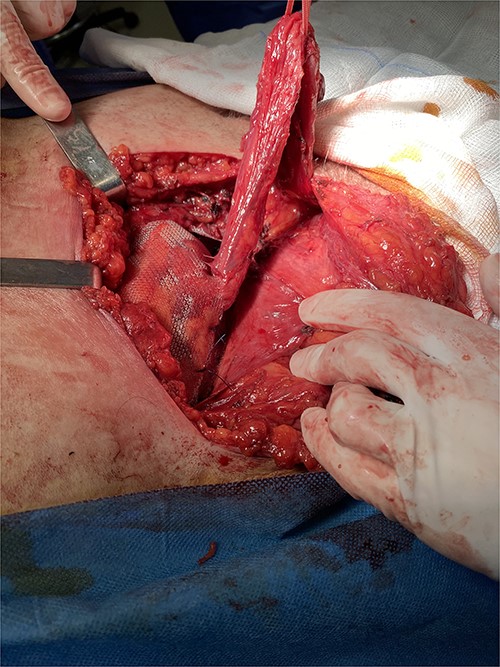 Intraoperative image showing the final reconstruction after mesh placement.
