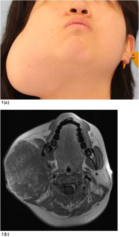 Preoperative condition. (a) A 16-year-old woman had a subcutaneous mass measuring 10 × 6 cm in the right parotid area. Her facial contours were asymmetrical. (b) MRI images displayed a 75 mm × 97 mm × 87 mm lobulated mass with heterogeneous internal contrast.