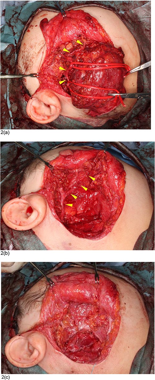 Intraoperative condition at the first surgery. (a) The marginal mandibular branch of the facial nerve (triangles) was identified on the surface of the mass at the mandibular area. (b) The facial nerve (triangles) was preserved after excision of the parotid VM. (c) The displaced superficial lobe of the parotid gland was repositioned to its original location and laid over the facial nerve.