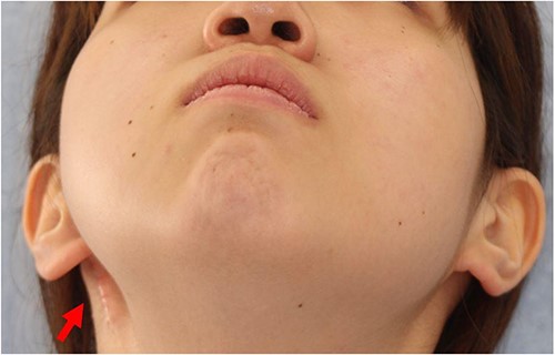 Postoperative condition 2 years after the first surgery. A concave deformity (arrow) was observed in the right parotid area.