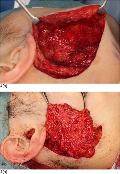 Intraoperative condition at the second surgery. (a) The concave, deformed area was dissected on the superficial lobe of the parotid gland. The facial nerve was not exposed, and injury to the facial nerve was safely avoided. (b) The flap was filled and firmly fixed into the concave deformity area.
