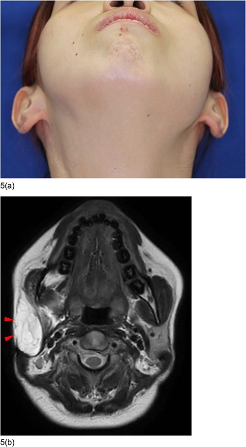Postoperative condition 6 years after the second surgery. (a) The concave deformity was improved and the facial contours became symmetrical. (b) MRI images showed that the concave deformed area was filled with fat of the flap (triangles).
