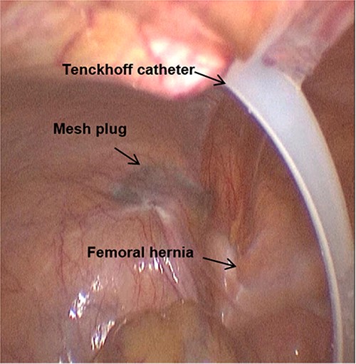 The mesh plug, Tenckhoff catheter, and femoral hernia are observed by laparoscopy.