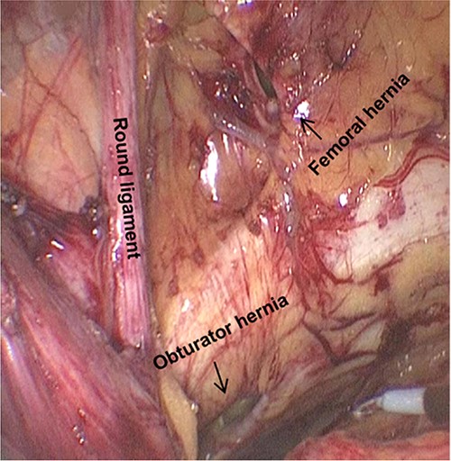 Femoral hernia and obturator hernia can be found after the medial dissection over the space of Retzius.