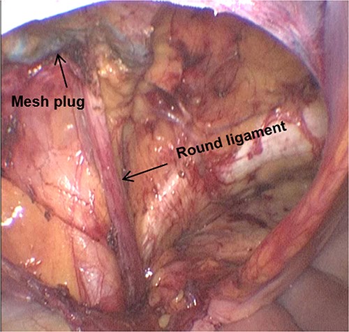 The dissected myopectineal orifice prior to mesh placement.