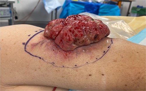 Pre-operative picture of a pedunculated, fungating tumour on the left arm of a 49-year-old female, with surrounding area of discolouration, which was included in the surgical resection.