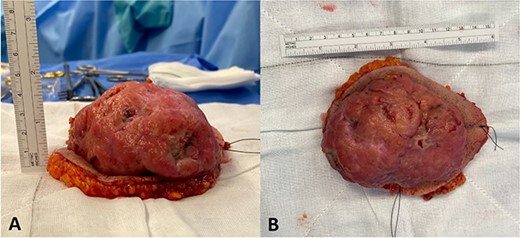 Post-excision pictures of the 101 × 71 × 22 mm tumour. (A) Inferior view (stitch lateral). (B) Anterior view (short stitch superior).