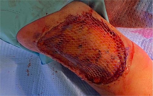 A split thickness, meshed 2:1 skin graft was applied to the left arm wound from a thigh donor site. The graft successfully took to the wound and healed well.