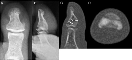 Plain radiographs (A) anterior–posterior view and (B) lateral view show an avulsion fracture of the dorsal base of the distal phalanx. Plain computed tomography (C) sagittal slice and (D) axial slice reveals an avulsion fracture of the dorsal base of the distal phalanx similar to the plain radiograph. Additionally, the fracture length line of the fragment was 5 mm.