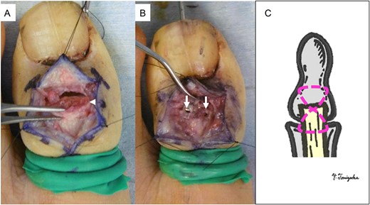 Operative findings (A) showed a bone fragment attached to the EHL (arrowhead) and (B) fixed with two screws (arrows). (C) Suture augmentation technique with FiberWire® (dotted line) proximally sutured to the EHL and distally sutured to the periosteum.