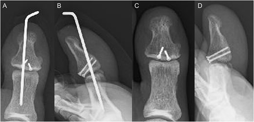Postoperative plain radiographs (A) anterior–posterior view and (B) lateral view show the fragment fixed with two screws and temporarily fixed IP joint with Kirschner wire. Plain radiograph 3 months after surgery (C) anterior–posterior view and (D) lateral view indicates the bone union.