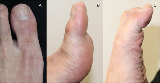 Physical findings 20 months after surgery (A) show EHL relief. Active motion shows IP joint range from (B) –3 to (C) 30°.
