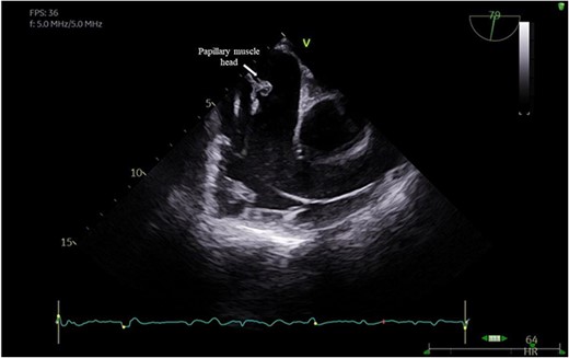 Flail anterior leaflet with associated papillary muscle head.