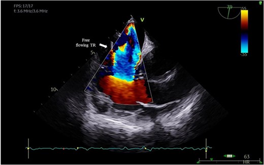 Colour Doppler showing free flowing TR.