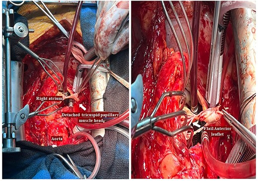 Intraoperative pictures demonstrating a flail anterior leaflet attached to the ruptured head of the papillary muscle.