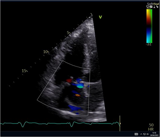 Post-operative ECHO showing a well seated TV.