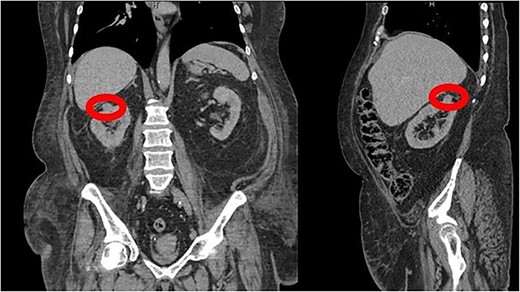 CT Urogram demonstrating a 1.6 cm enhancing right renal mass suspicious for renal cell carcinoma.