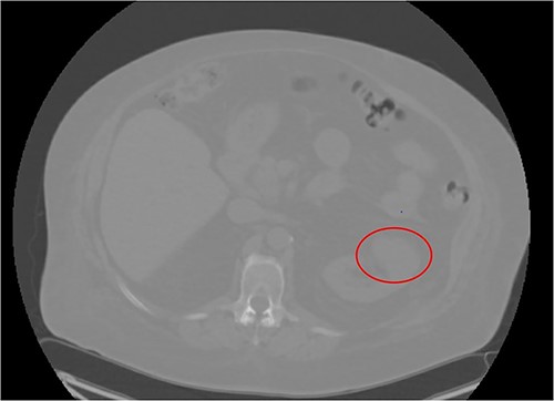 CT Urogram demonstrating right renal mass suspicious for neoplasm.